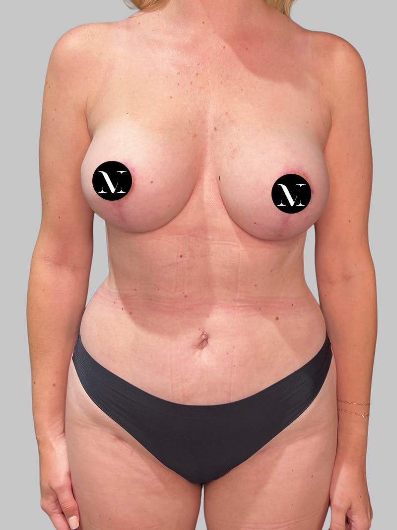 Liposuction Before & After Gallery - Patient 753177 - Image 2