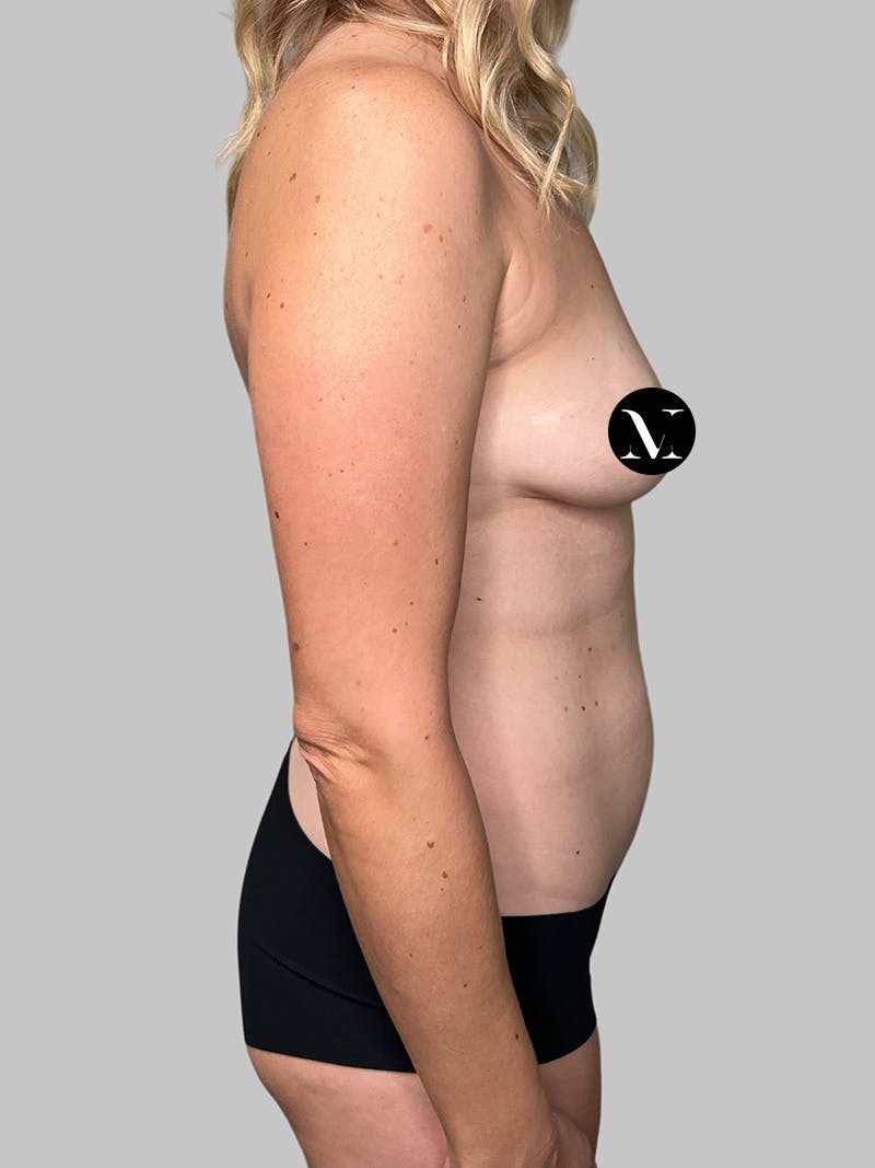 Liposuction Before & After Gallery - Patient 753177 - Image 5