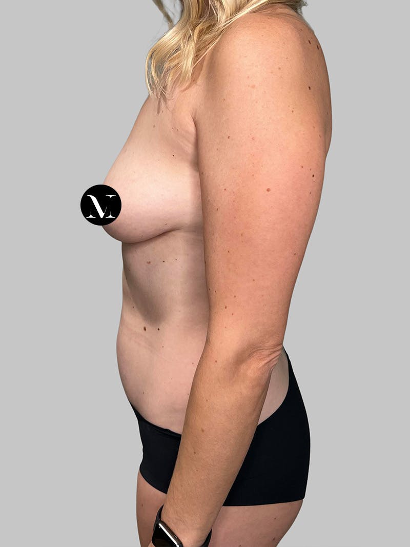 Liposuction Before & After Gallery - Patient 753177 - Image 9