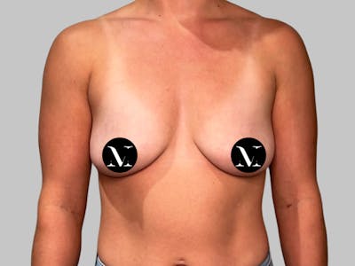 Breast Augmentation Before & After Gallery - Patient 980371 - Image 1
