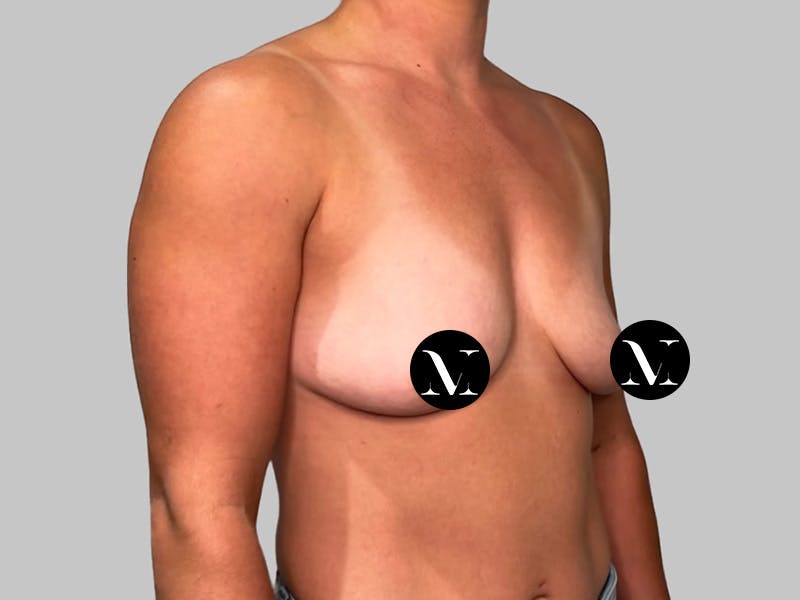 Breast Augmentation Before & After Gallery - Patient 980371 - Image 3