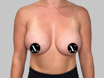 Breast Augmentation Before & After Gallery - Patient 980371 - Image 2
