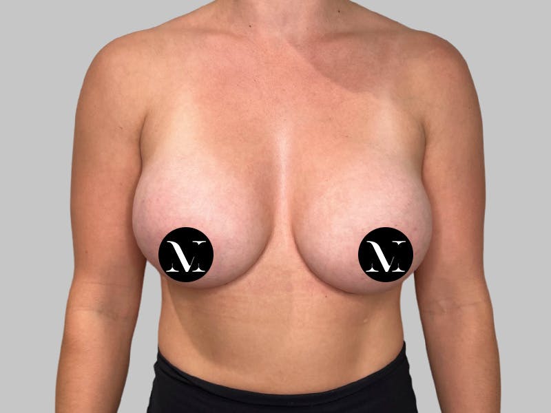 Breast Augmentation Before & After Gallery - Patient 980371 - Image 2