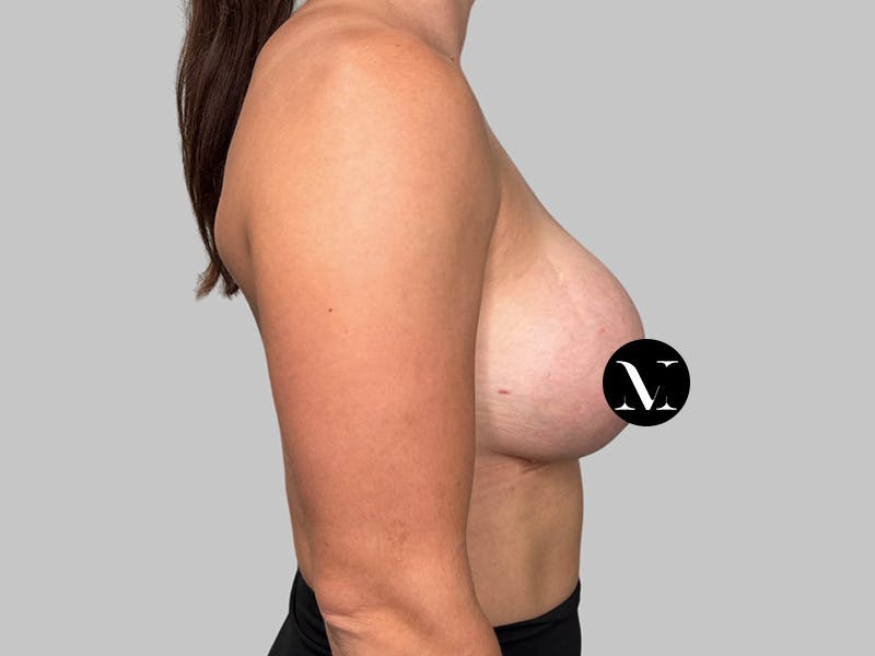 Breast Augmentation Before & After Gallery - Patient 980371 - Image 6