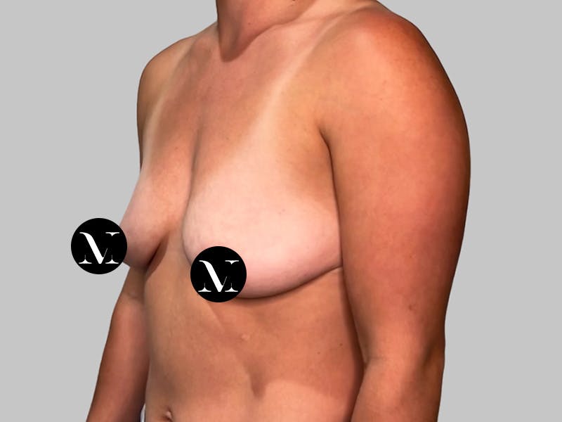 Breast Augmentation Before & After Gallery - Patient 980371 - Image 7