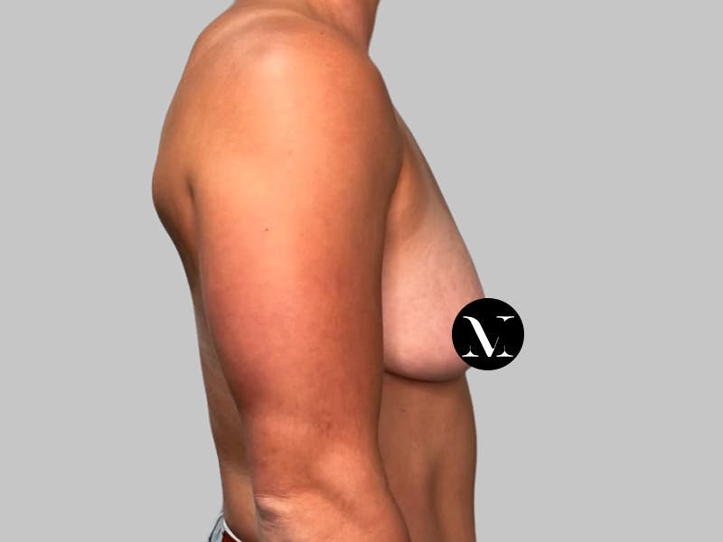 Breast Augmentation Before & After Gallery - Patient 980371 - Image 5