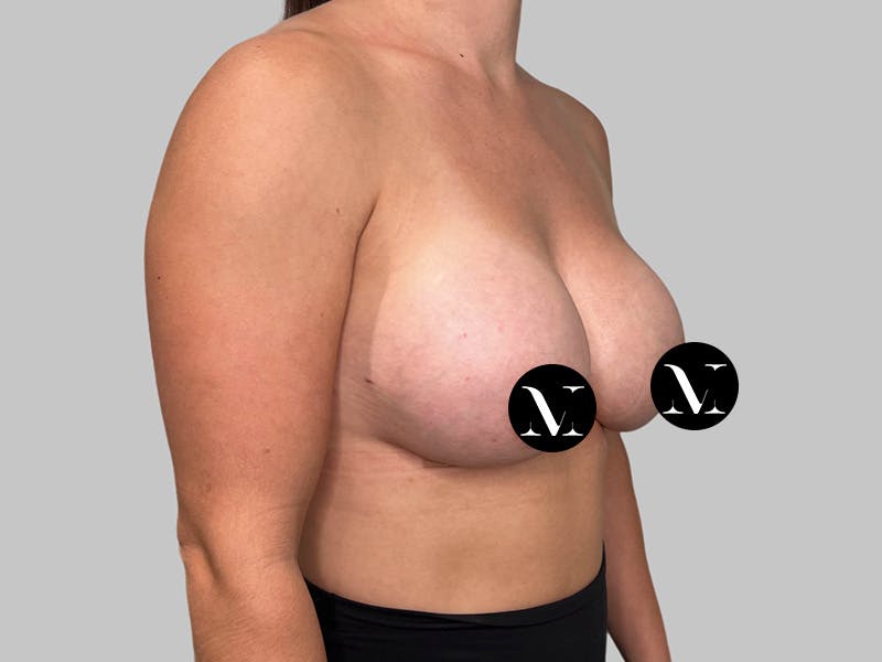 Breast Augmentation Before & After Gallery - Patient 980371 - Image 4