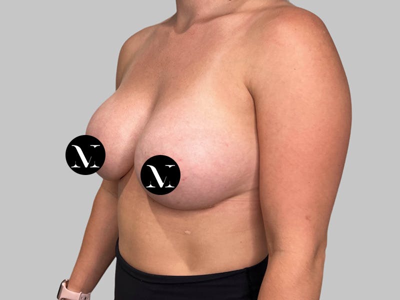 Breast Augmentation Before & After Gallery - Patient 980371 - Image 8