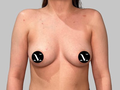 Breast Augmentation Before & After Gallery - Patient 541925 - Image 1