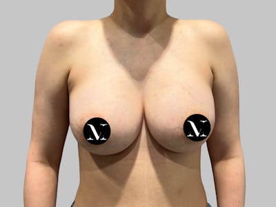 Breast Augmentation Before & After Gallery - Patient 541925 - Image 2