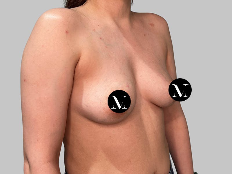 Breast Augmentation Before & After Gallery - Patient 541925 - Image 3