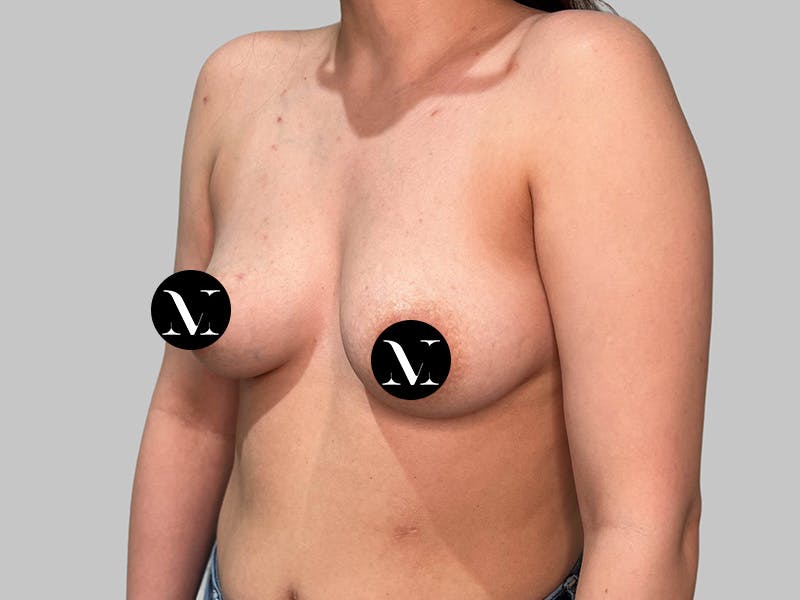 Breast Augmentation Before & After Gallery - Patient 541925 - Image 5