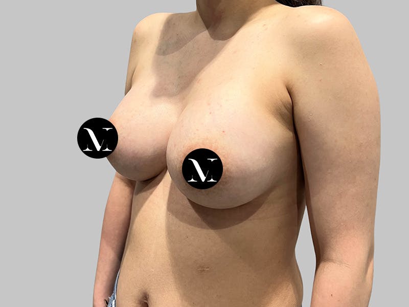 Breast Augmentation Before & After Gallery - Patient 541925 - Image 6