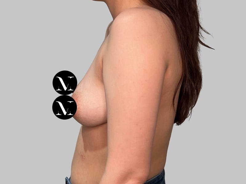 Breast Augmentation Before & After Gallery - Patient 541925 - Image 7