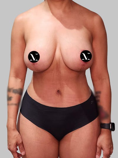 Tummy Tuck Before & After Gallery - Patient 680782 - Image 2