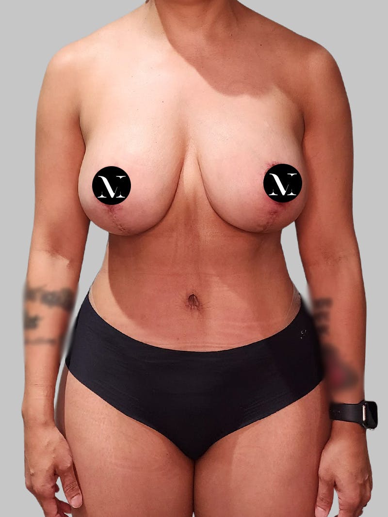 Tummy Tuck Before & After Gallery - Patient 680782 - Image 2