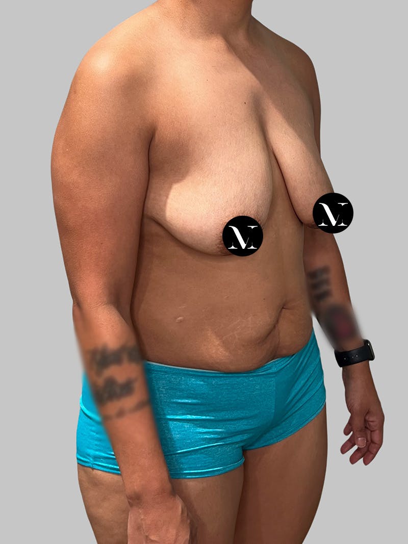 Tummy Tuck Before & After Gallery - Patient 680782 - Image 3