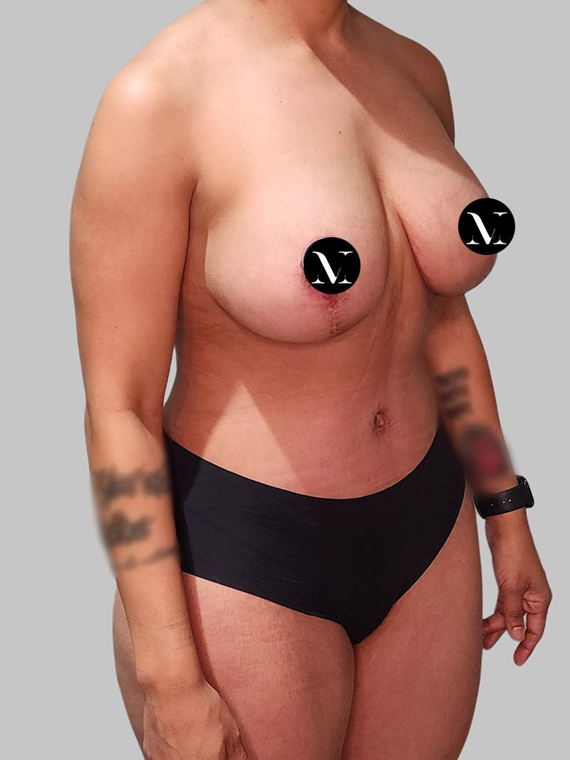 Tummy Tuck Before & After Gallery - Patient 680782 - Image 4