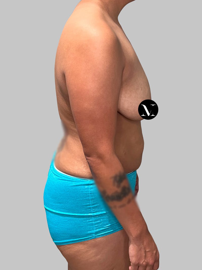 Tummy Tuck Before & After Gallery - Patient 680782 - Image 5