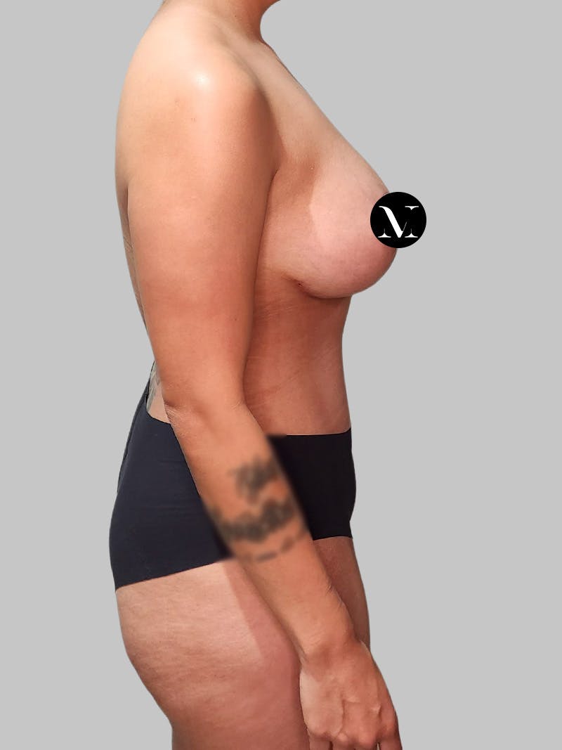 Tummy Tuck Before & After Gallery - Patient 680782 - Image 6