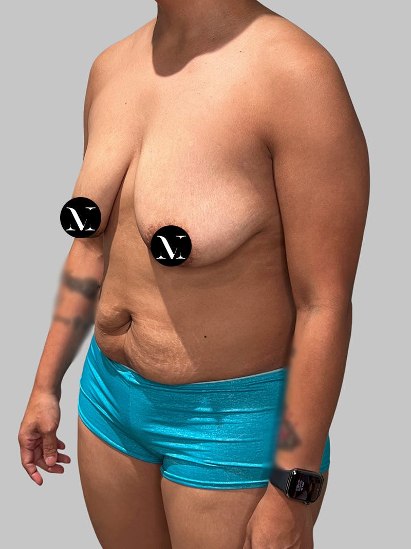 Tummy Tuck Before & After Gallery - Patient 680782 - Image 7