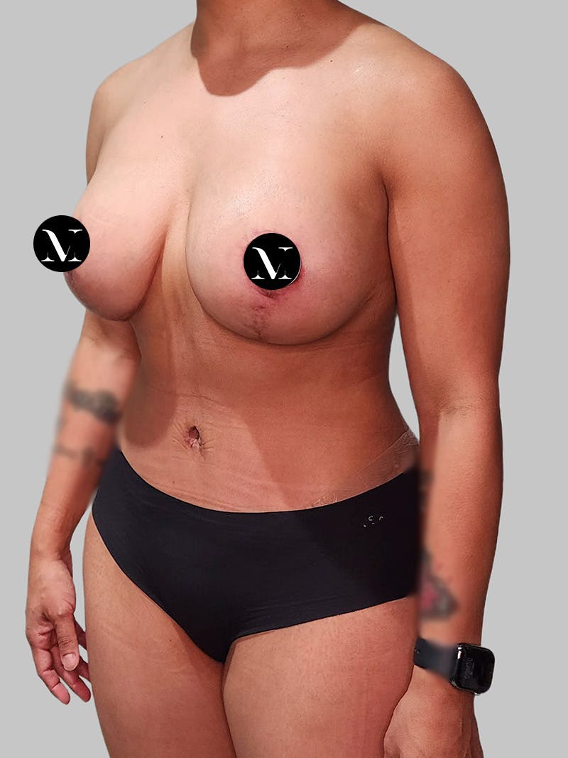 Tummy Tuck Before & After Gallery - Patient 680782 - Image 8