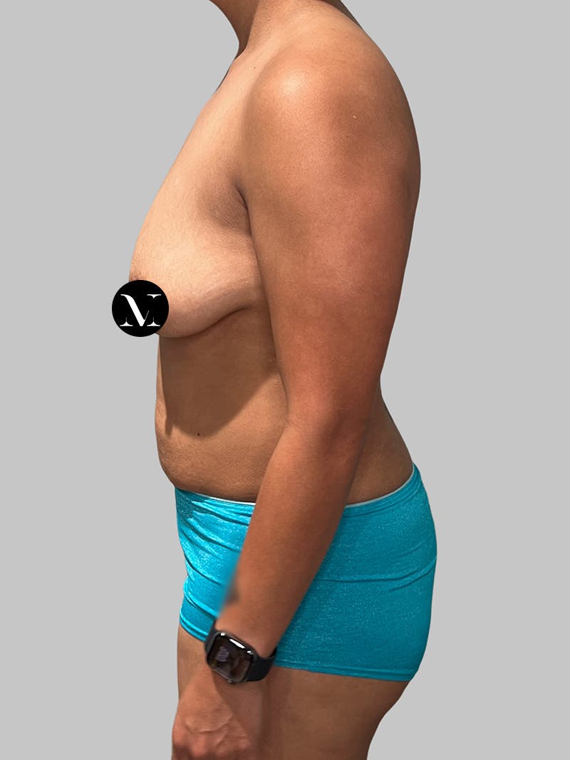 Tummy Tuck Before & After Gallery - Patient 680782 - Image 9