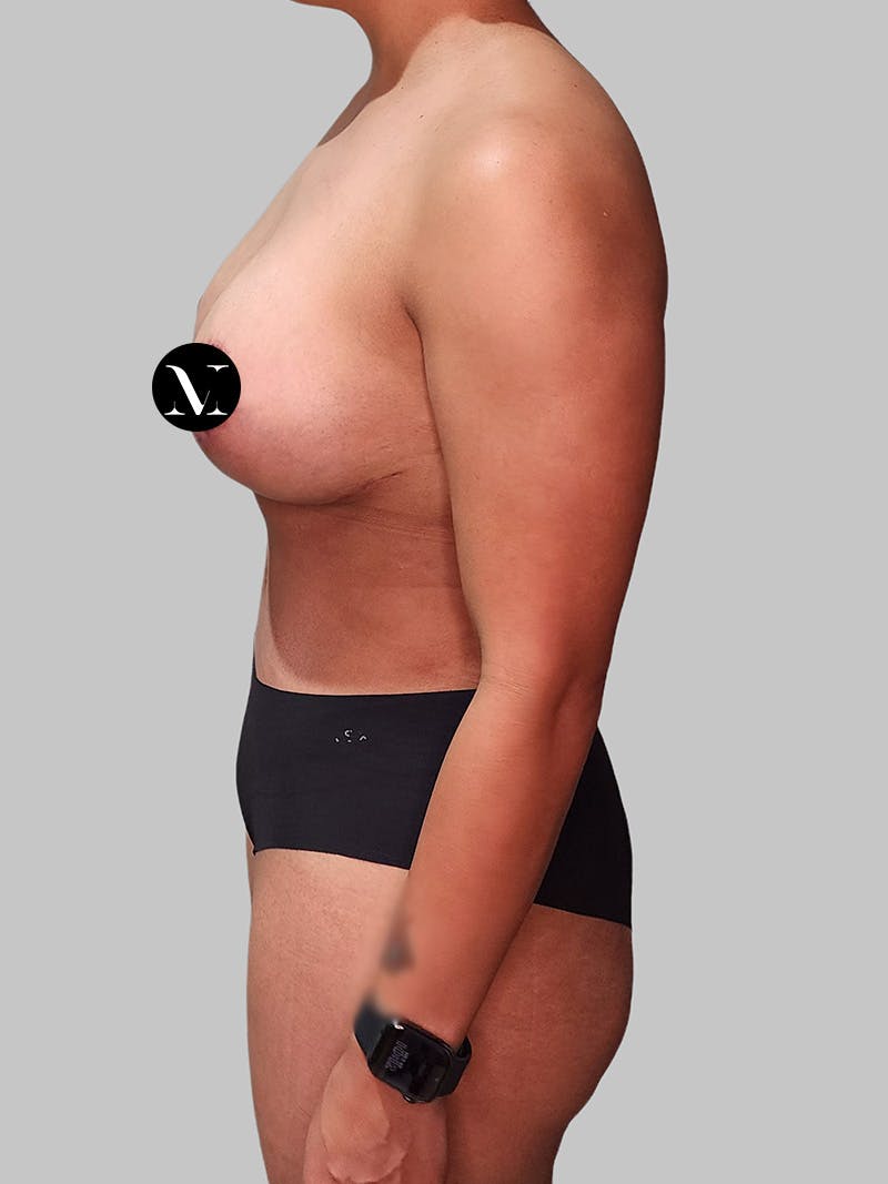 Tummy Tuck Before & After Gallery - Patient 680782 - Image 10