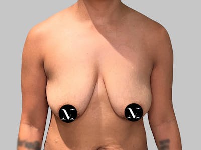 Breast Augmentation Before & After Gallery - Patient 572635 - Image 1