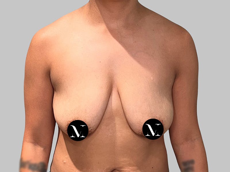 Breast Augmentation Before & After Gallery - Patient 572635 - Image 1