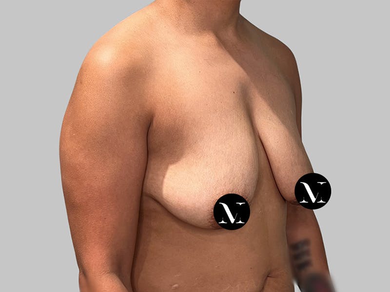 Breast Augmentation Before & After Gallery - Patient 572635 - Image 3