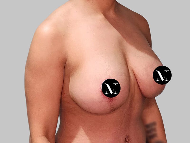 Breast Augmentation Before & After Gallery - Patient 572635 - Image 4
