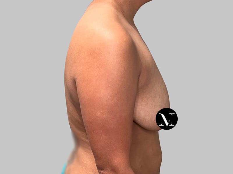 Breast Augmentation Before & After Gallery - Patient 572635 - Image 5