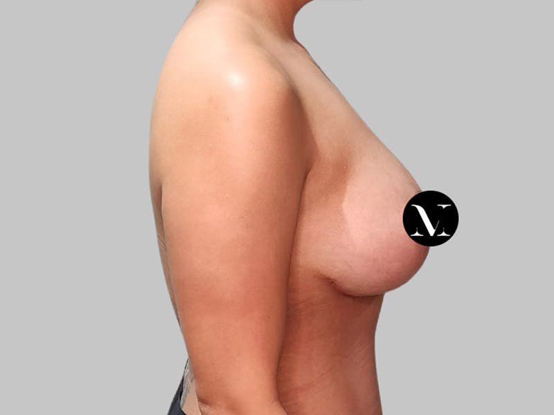Breast Augmentation Before & After Gallery - Patient 572635 - Image 6