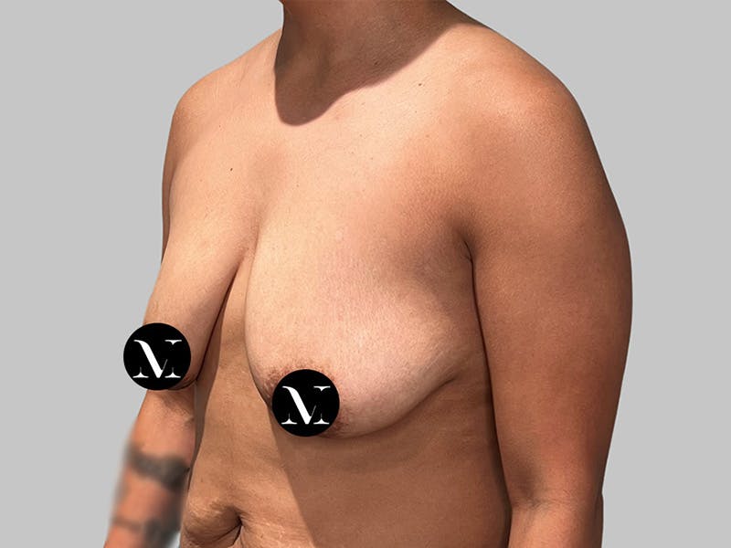 Breast Augmentation Before & After Gallery - Patient 572635 - Image 7