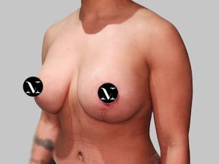 Breast Augmentation Before & After Gallery - Patient 572635 - Image 8