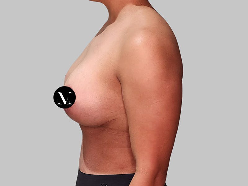 Breast Augmentation Before & After Gallery - Patient 572635 - Image 10