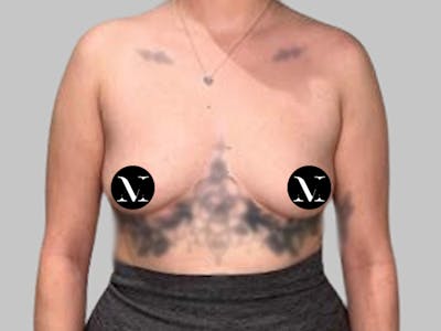 Breast Augmentation Before & After Gallery - Patient 250131 - Image 1