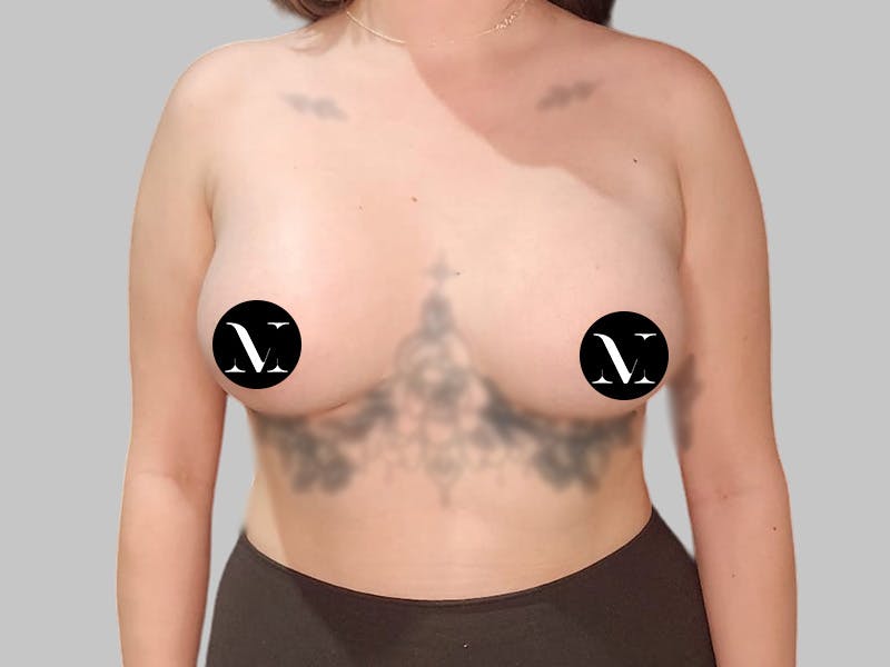 Breast Augmentation Before & After Gallery - Patient 250131 - Image 2