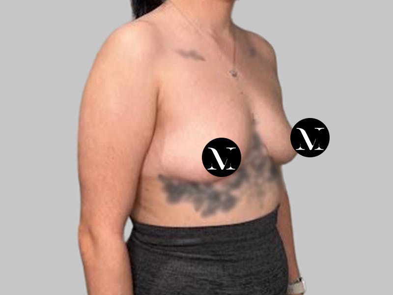 Breast Augmentation Before & After Gallery - Patient 250131 - Image 3