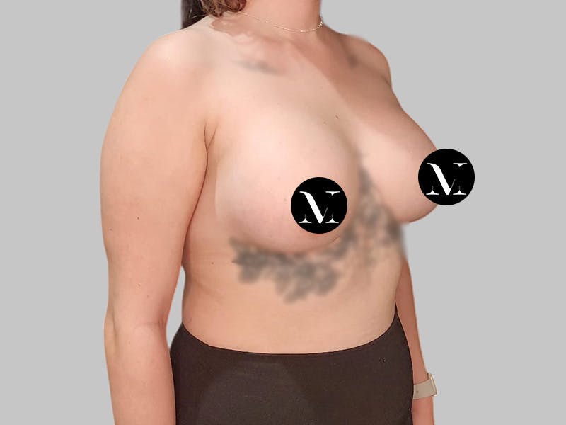 Breast Augmentation Before & After Gallery - Patient 250131 - Image 4
