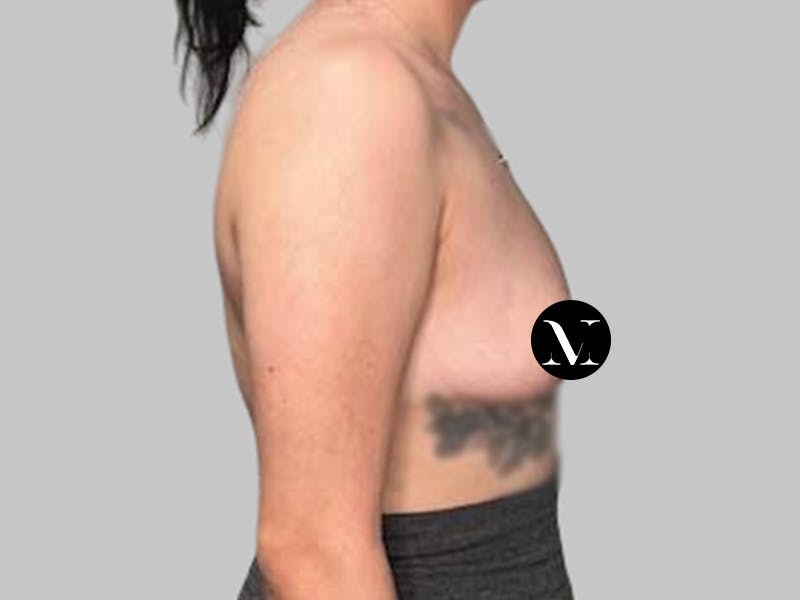 Breast Augmentation Before & After Gallery - Patient 250131 - Image 5