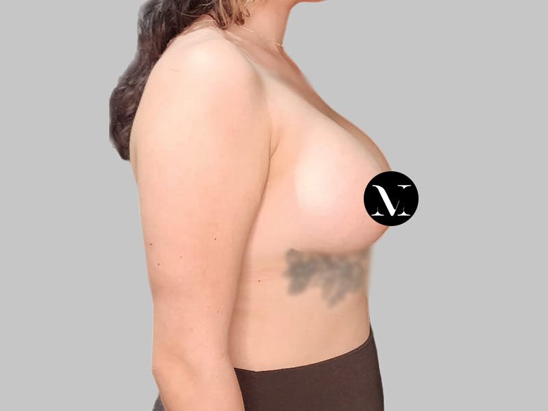 Breast Augmentation Before & After Gallery - Patient 250131 - Image 6