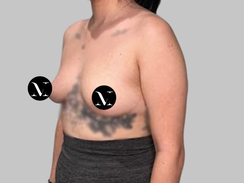 Breast Augmentation Before & After Gallery - Patient 250131 - Image 7