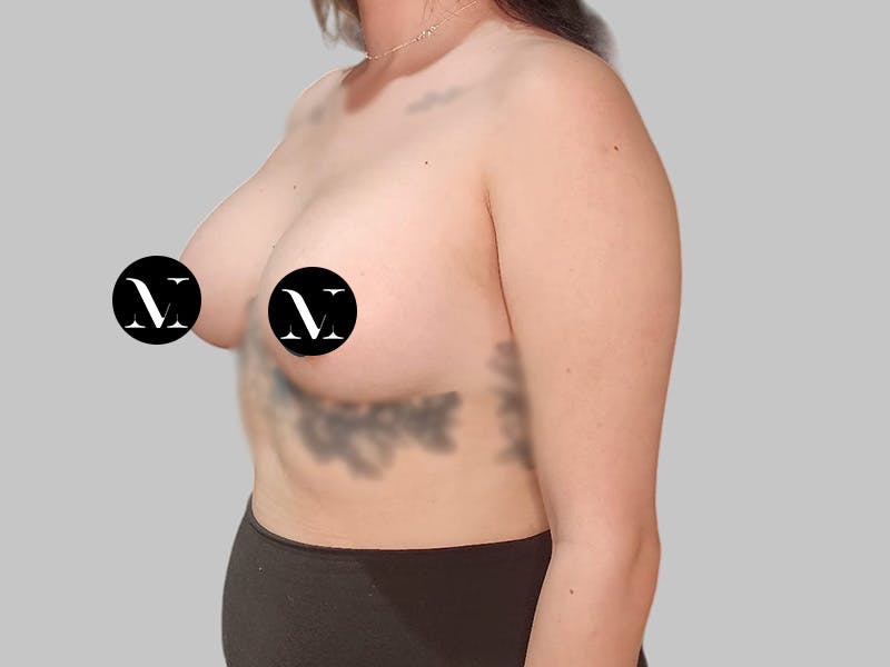 Breast Augmentation Before & After Gallery - Patient 250131 - Image 8