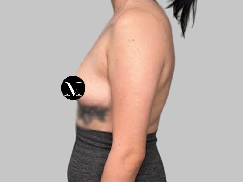 Breast Augmentation Before & After Gallery - Patient 250131 - Image 9