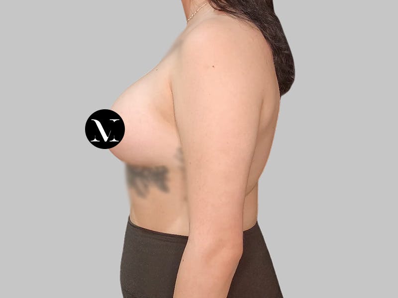 Breast Augmentation Before & After Gallery - Patient 250131 - Image 10