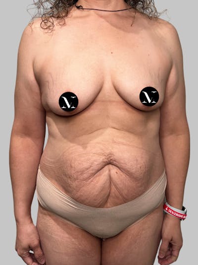 Tummy Tuck Before & After Gallery - Patient 914359 - Image 1
