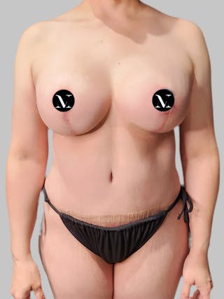 Tummy Tuck Before & After Gallery - Patient 914359 - Image 2