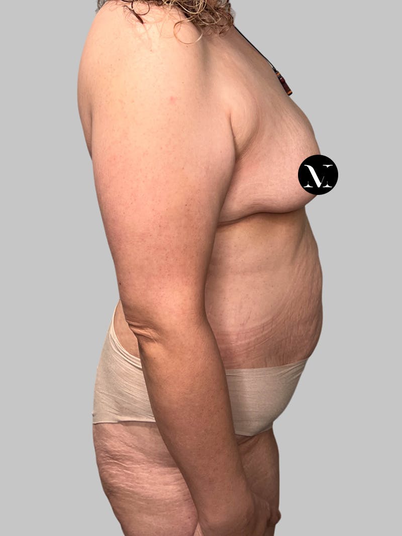 Tummy Tuck Before & After Gallery - Patient 914359 - Image 3